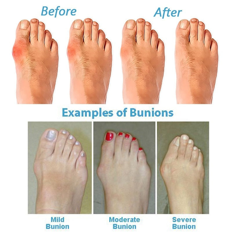 HexoBunion™ Orthopedic Bunion Corrector Sandals