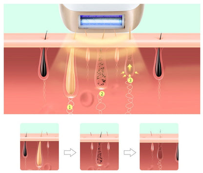 HexoSkin™ IPL Laser Hair Removal Device