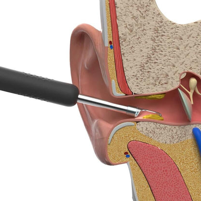 Bebird™ Intelligent Earwax Removal Otoscope