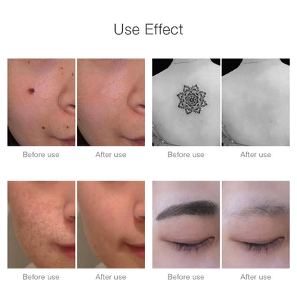 Neatcell™ – Picosecond Laser Remover For Tattoos & Spots